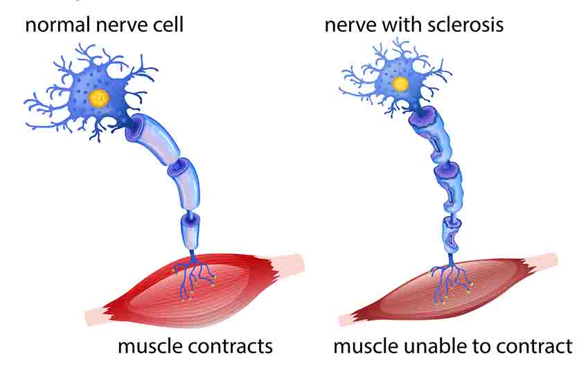 normal nerve cell